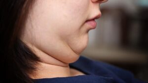 How to Get Rid of Double Chin