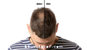 5 Factors To Consider When Choosing A Hair Loss Treatment