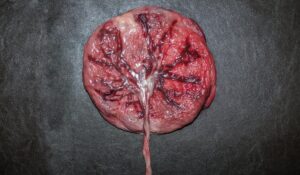 Posterior Placenta 