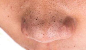 How To Remove Pimple Marks Naturally At Home