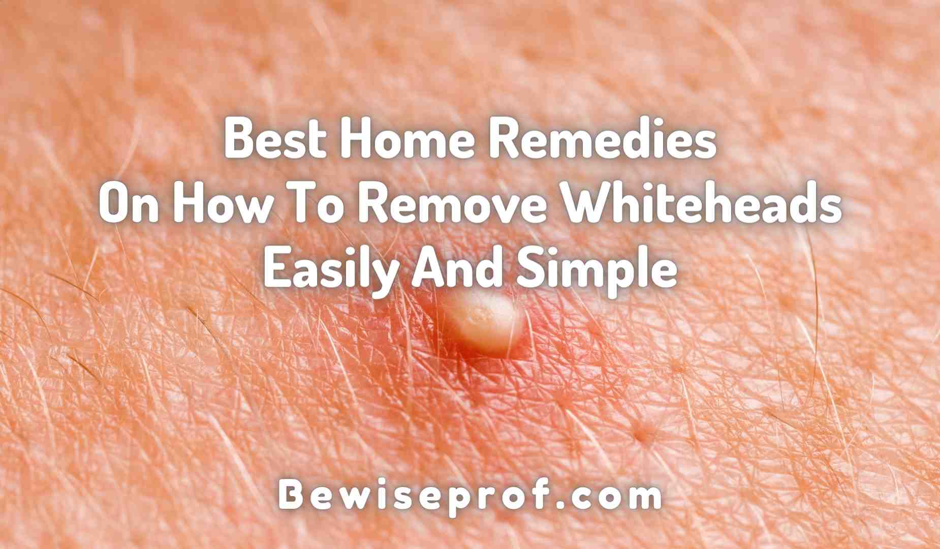 Best Home Remedies On How To Remove Whiteheads Easily And Simple