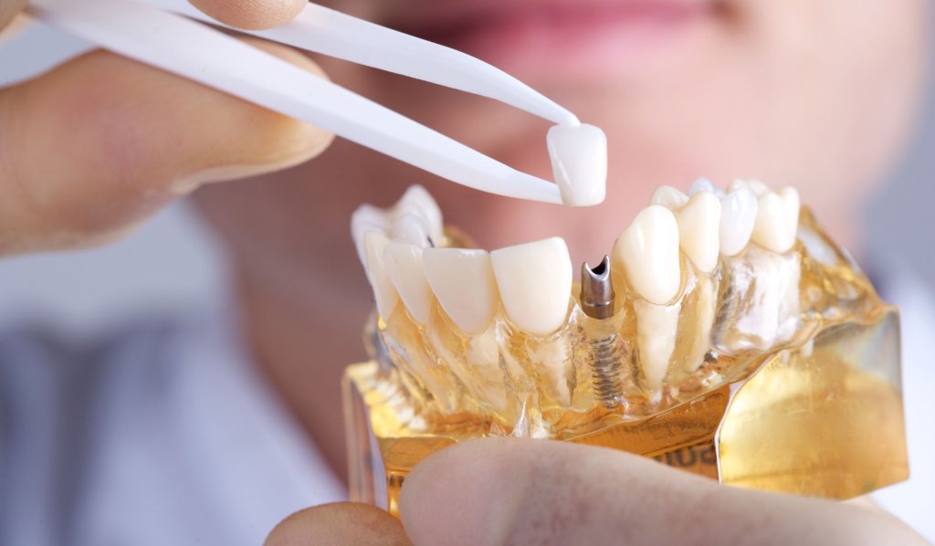 What Is The Dental Implant Process?