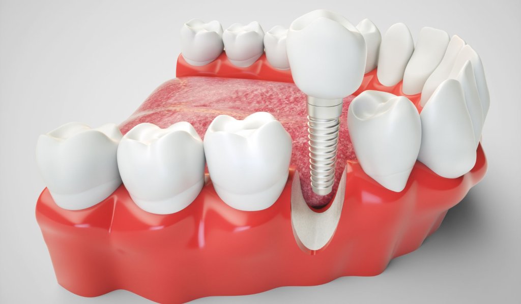 The True Cost Of Dental Implants