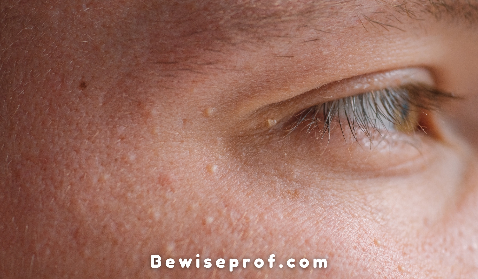 Milialar | What Is Milia On Eyelid, Causes, Symptoms And Treatment