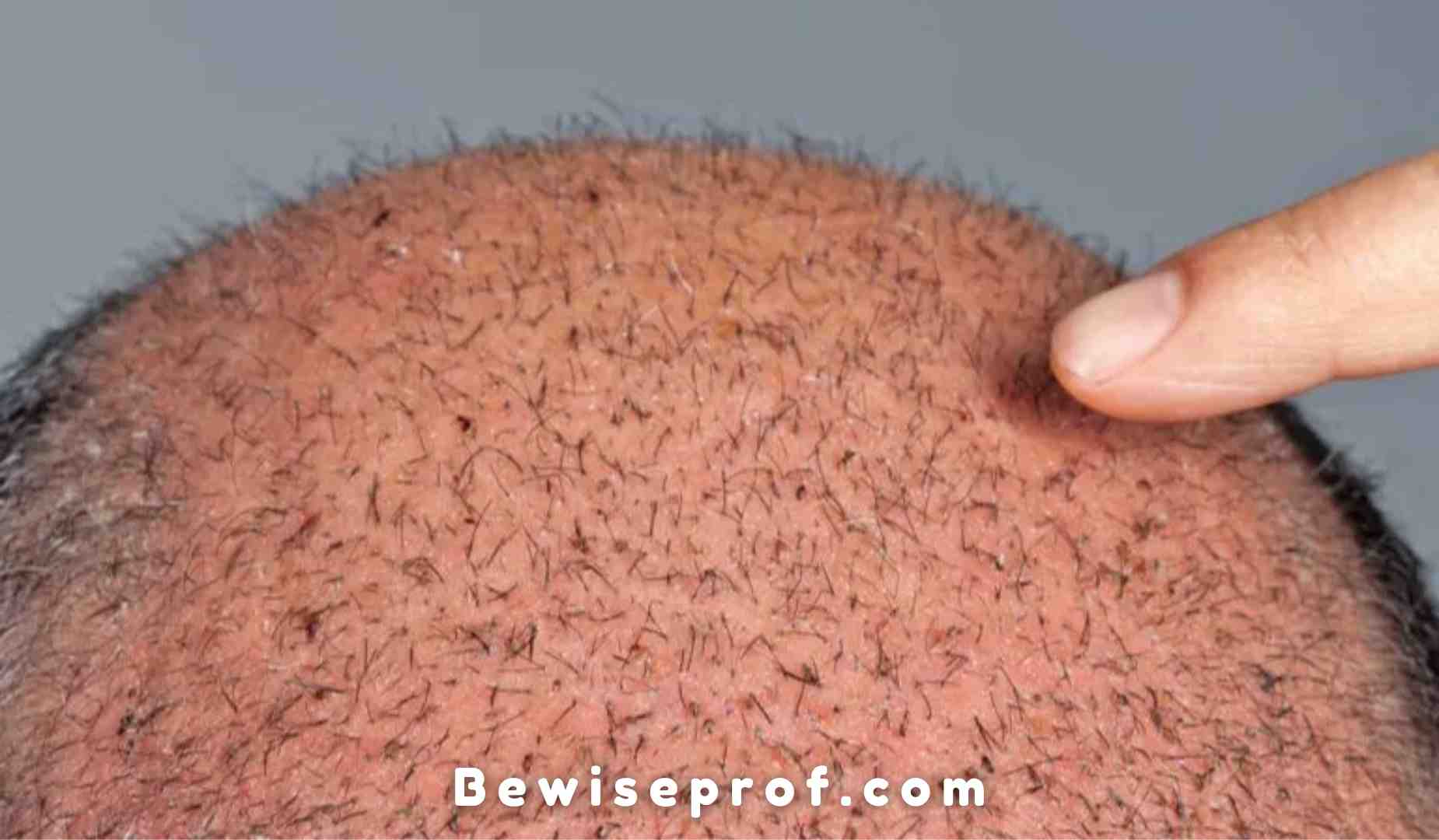 Thinning Tresses: Reviving Confidence With Hair Transplant Solutions